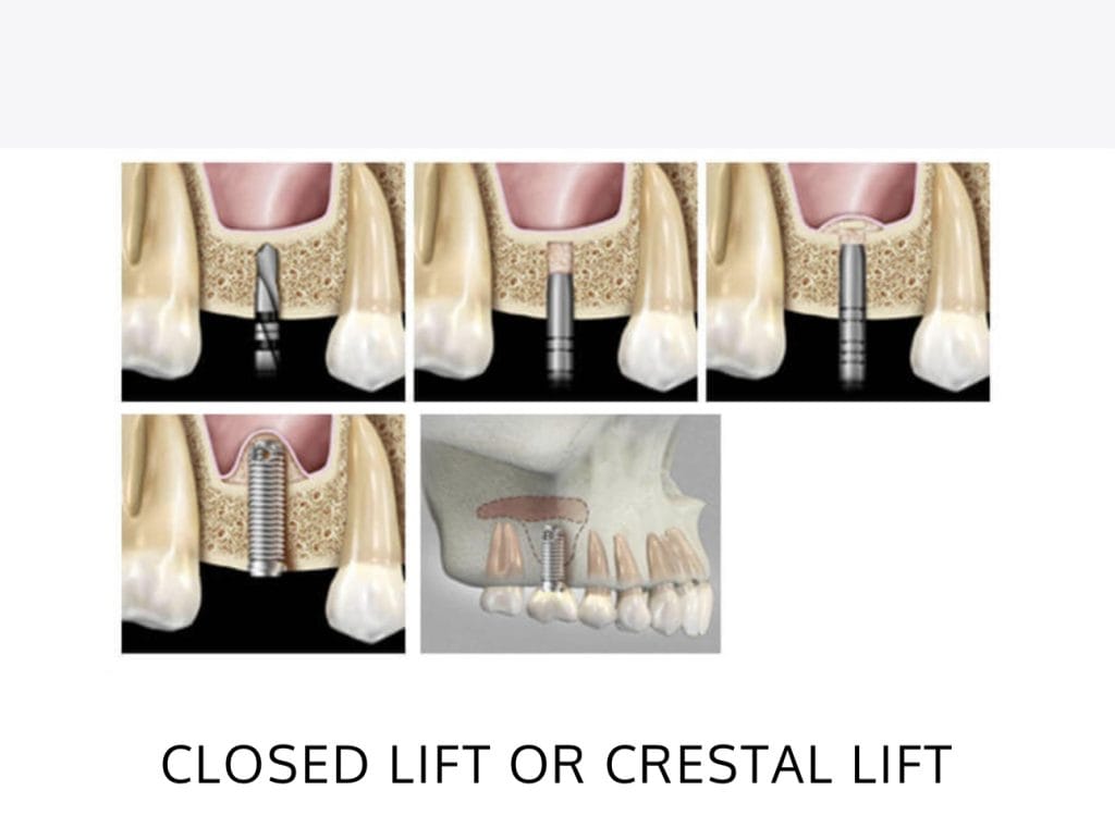 Sinus Lifts - Nuevo Dental