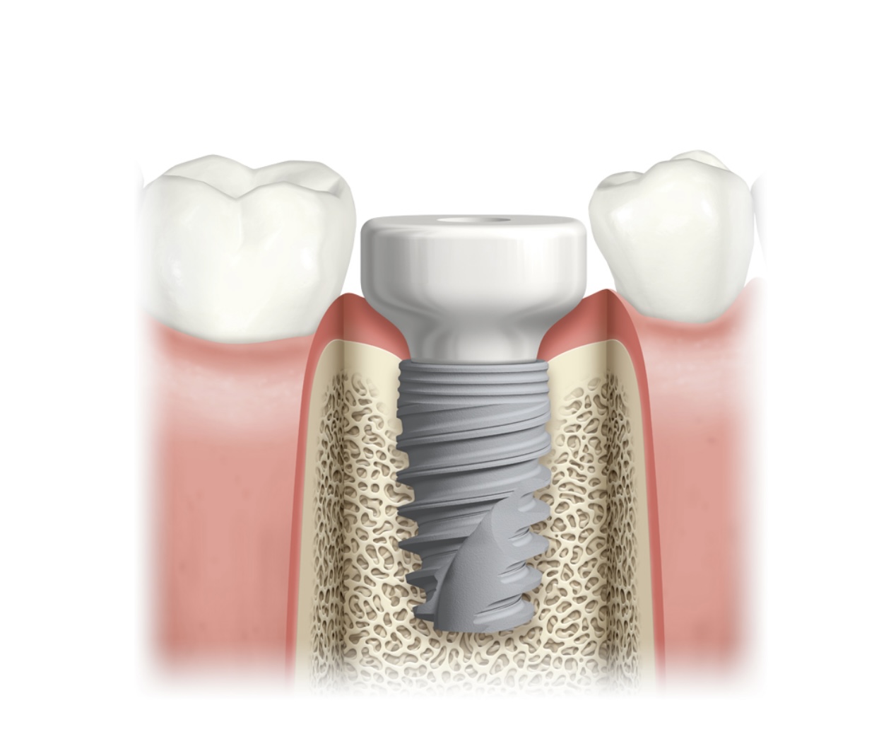 dental-implants-nuevo-dental