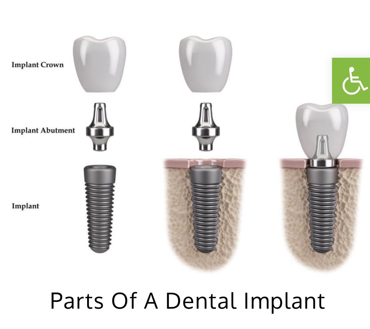 dental-implants