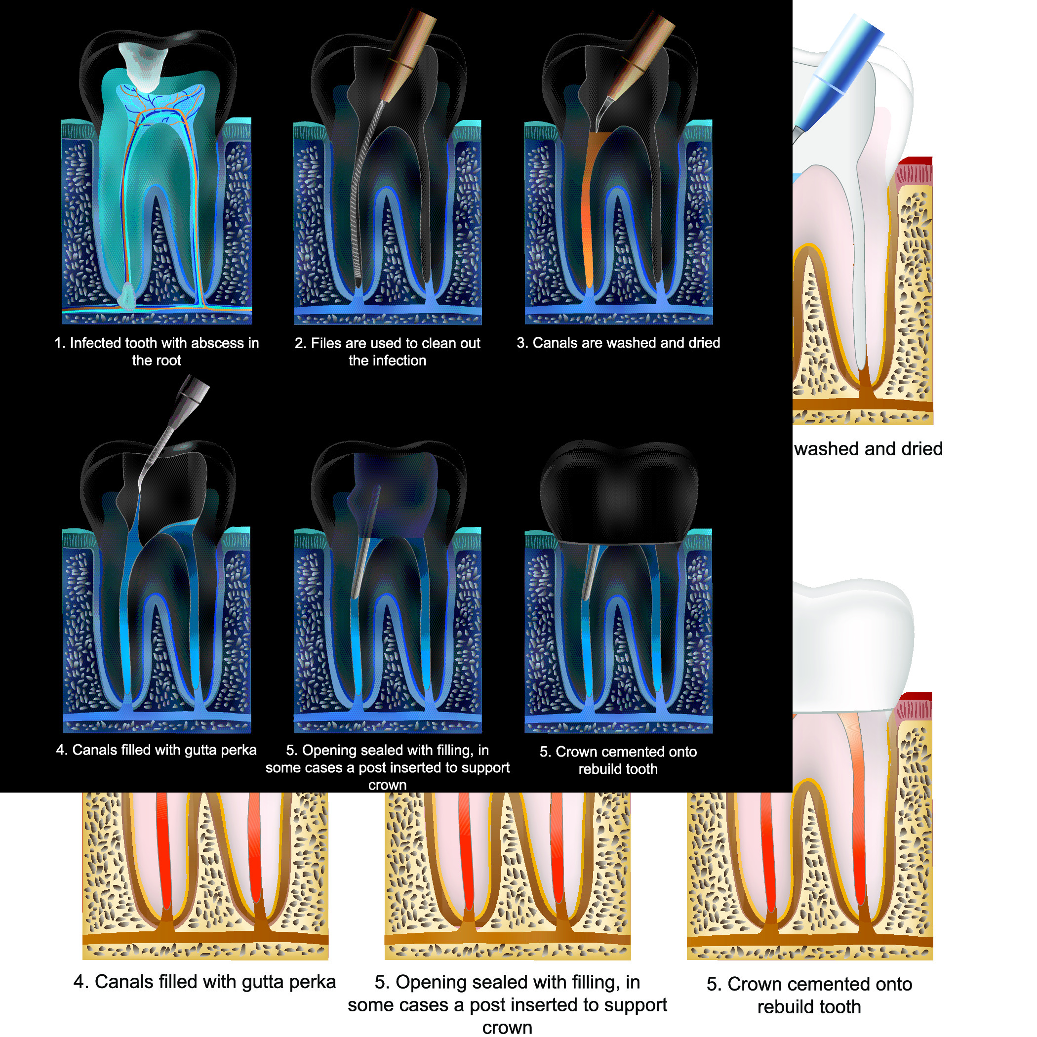 root-canal-explained