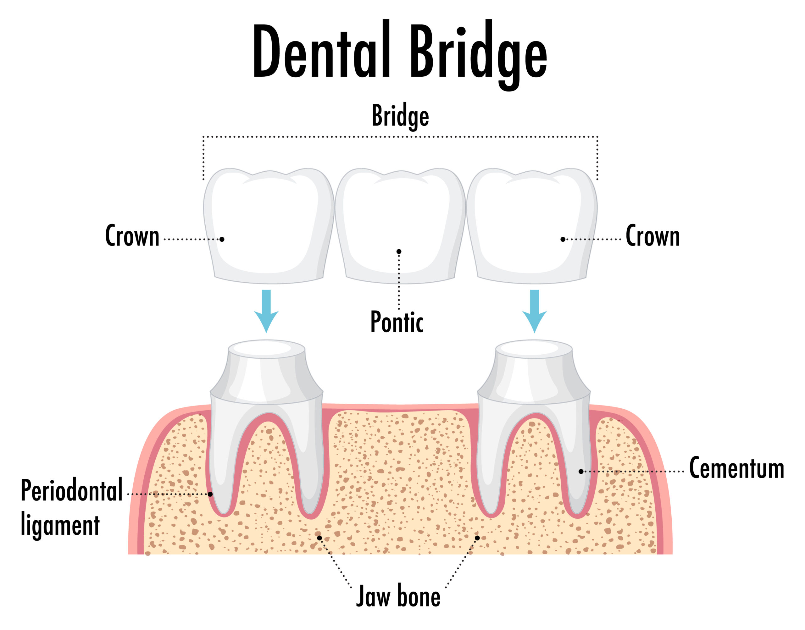 dental-bridges