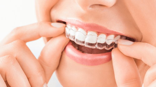 invisalign