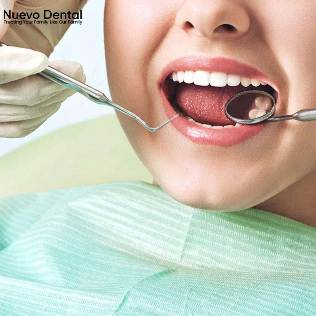 Dental Fillings in North Hollywood