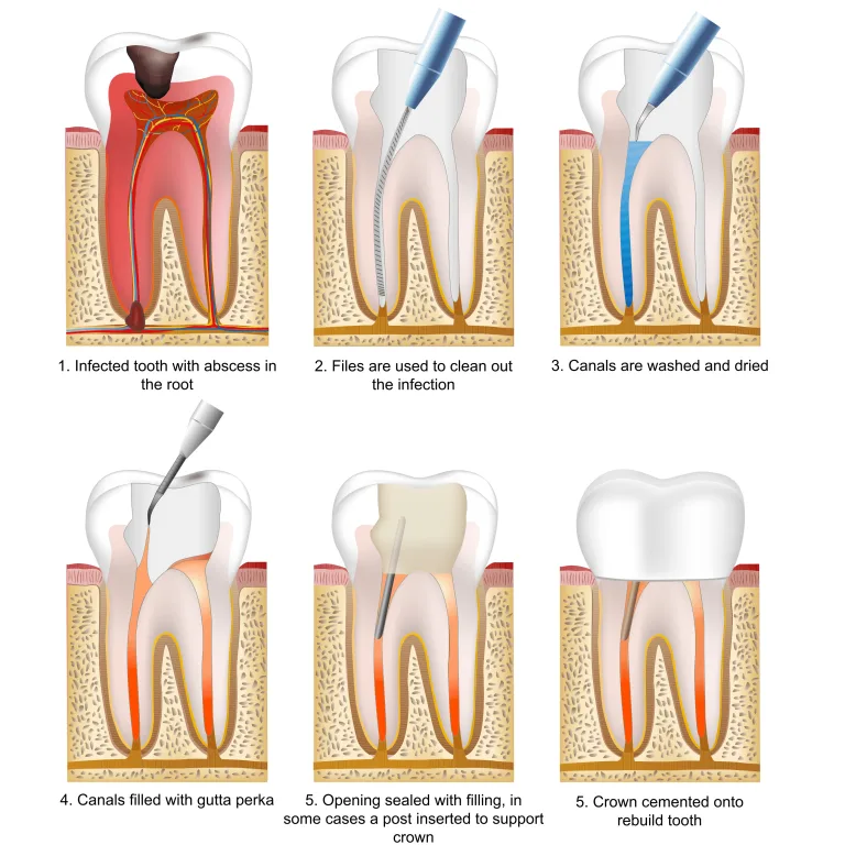root canal treatment